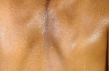 肝斑和黄褐斑的区别(肝斑和黄褐斑的区别，你了解吗？)